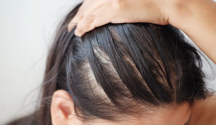 Tìm hiểu ngọn ngành nguyên nhân và cách điều trị rụng tóc ở nữ giới - Phòng  Khám Cấy Ghép Tóc Y Học Quốc Tế