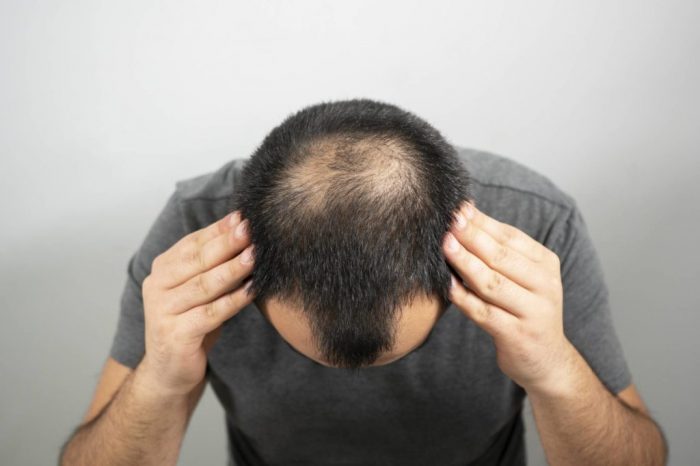 Rụng tóc từng mảng: Nguyên nhân, biểu hiện, cách điều trị