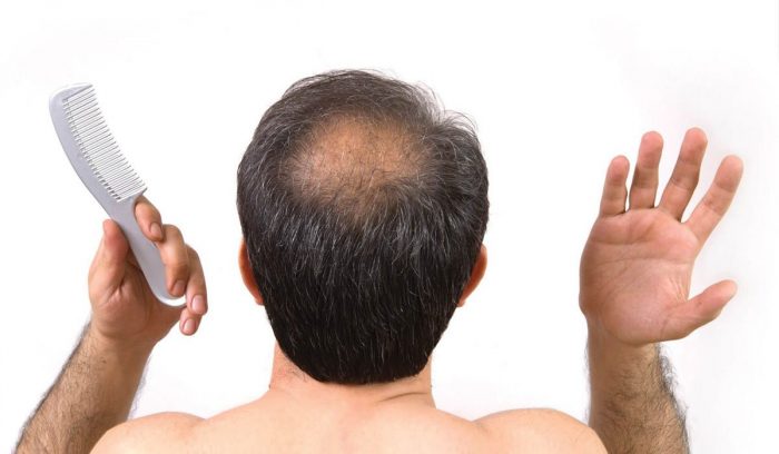 Nguyên nhân rụng tóc ở nam giới và cách điều trị hiệu quả